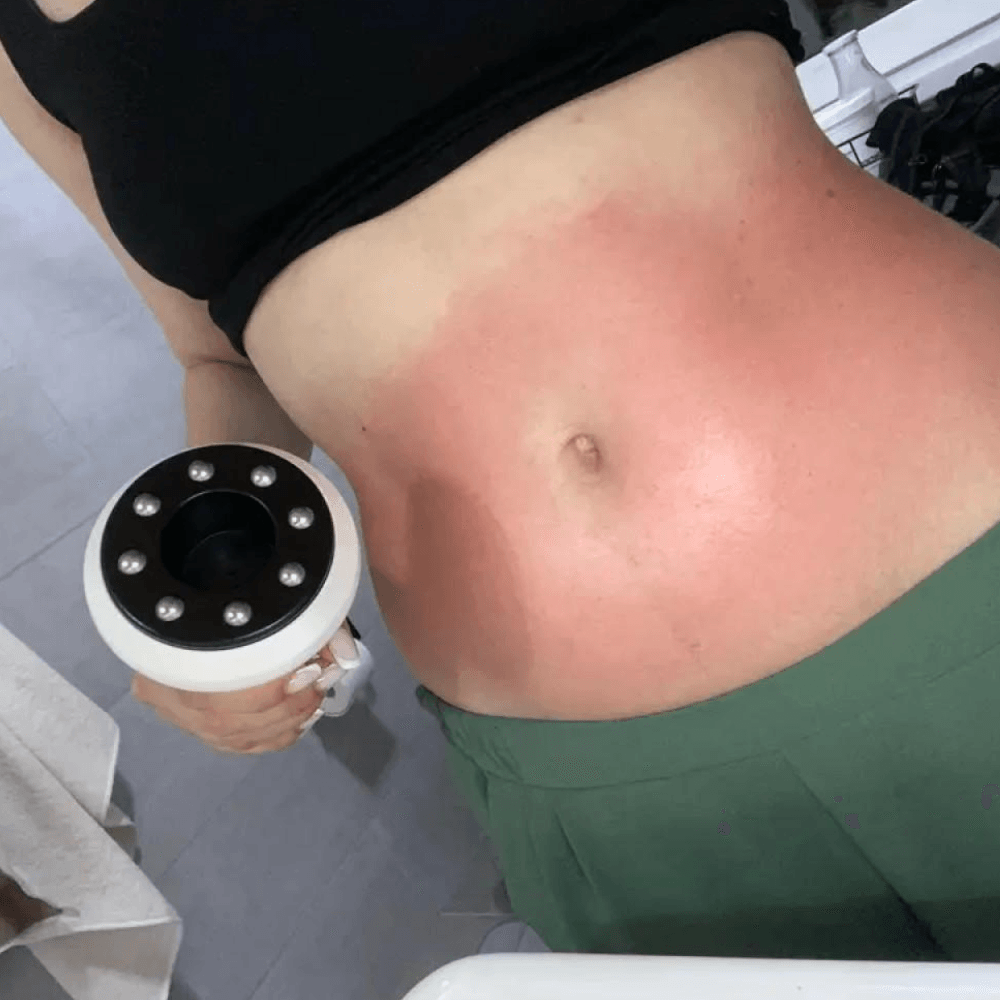 Masajeador anticelulítico con succión al vacío